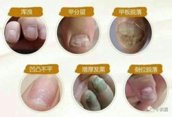孕期灰指甲怎么办（孕妇有灰指甲怎么办?）