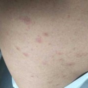 谁那有风疹的图片啊？急用,孕期风疹图片和症状图片