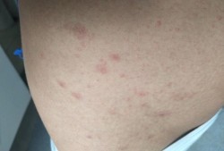 谁那有风疹的图片啊？急用,孕期风疹图片和症状图片