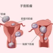 子宫肌瘤对胎儿的影响（子宫肌瘤对胎儿的影响大吗）