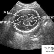 胎儿脑侧宽多吗（怀孕26周胎儿左侧侧脑室宽1.02正常吗）