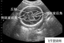 胎儿脑侧宽多吗（怀孕26周胎儿左侧侧脑室宽1.02正常吗）