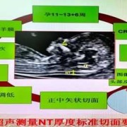 胎儿nt增厚（ntlf厚代表什么）