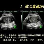 超声对胎儿的影响（超声对胎儿的影响有哪些）