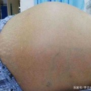 小孩腹腔积液是怎么回事,胎儿腹腔少量积液是什么意思