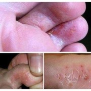 怀孕脚气严重怎么办,孕期脚气严重对胎儿有影响吗