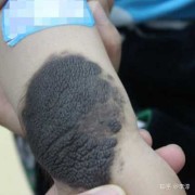 胎儿为什么会得兽皮痣（胎儿为什么会得兽皮痣的原因）