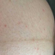 孕期肚子红点（孕期肚子长红点怎么回事）