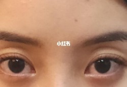 胎儿眼窝深（胎儿眼窝深是不是眼睛就大）