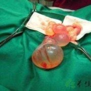 怀孕期有囊肿（孕期卵巢囊肿怎么办）