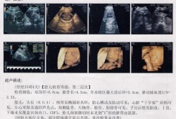 怀孕25周，胎宝头偏大要紧么,胎儿头围偏大是男孩吗还是女孩