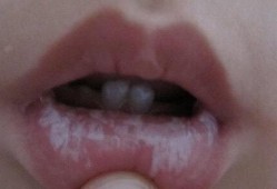 胎儿鹅口疮能治好吗（胎儿鹅口疮好治疗吗）