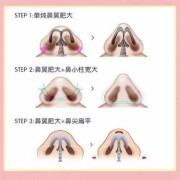 胎儿鼻前皮肤增厚（胎儿鼻前皮肤增厚畸形几率）