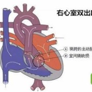 右心房的入口和出口,胎儿右室双出口怎么办