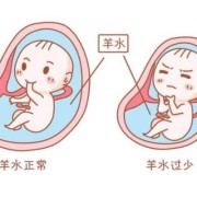 胎儿吞羊水（羊水多吃什么排水）