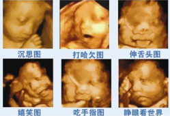 孕妇四维显示宝宝右下腹囊性包块,胎儿囊性包块会自己消失吗