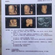 胎儿肾畸形（孕22周做胎儿的四维b超右肾缺失该怎么办）