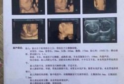 胎儿肾畸形（孕22周做胎儿的四维b超右肾缺失该怎么办）