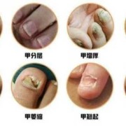 怀孕期间可以治疗灰指甲吗（怀孕期间可以治疗灰指甲吗有影响吗）
