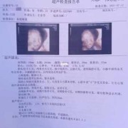孕期不忌嘴（孕期不忌嘴唐筛四维都过了胎儿）