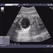 胎儿腹腔囊肿（胎儿腹腔囊肿）