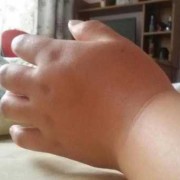 孕期腕管综合症（孕30周了，手肿麻木正常吗）