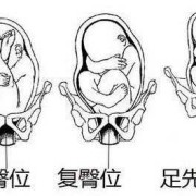 胎儿臀围（胎位臂位是什么意思）