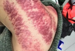孕妇感冒可以刮痧吗,孕期可以刮痧吗只刮脖子