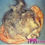 孕期畸胎瘤（孕期畸胎瘤）