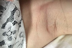 有没有孕期腋下变得很黑，或哪些部位变黑的,孕期腋下疼是怎么回事