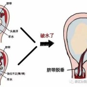 孕期怎么预防胎膜早破（内裤有一小片湿算破水吗）