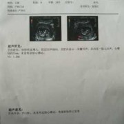 胎停原因是什么,胎儿胎停的原因有哪些