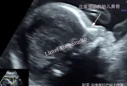 24周胎儿鼻骨正常值（24周胎儿鼻骨长度标准）