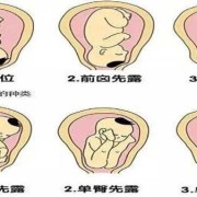 胎儿左枕位（请问左枕后位是什么意思）