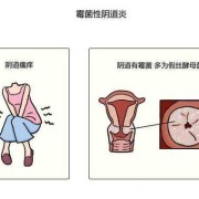 孕期一直霉菌快要生了（孕期一直霉菌快要生了怎么办）