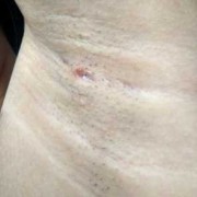 孕期腋下有肿块（腋下肿块是怎么回事）