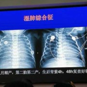 ct对胎儿有影响吗（婴儿做CT有副作用吗）