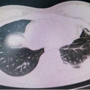 两肺感染性病变TB可能大右侧胸腔积液是什么病,胎儿右侧胸腔积液是怎么造成的