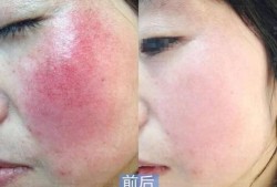 怀孕四个月了流一点血丝是怎么回事,孕期红血丝分泌