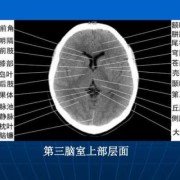 胎儿第三脑室（三脑室及双侧脑室大怎么回事）
