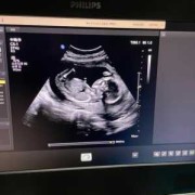 胎儿17周发育稳定了吗？正常多少周就稳定了呢,怀孕17周胎儿稳定了吗吃什么好