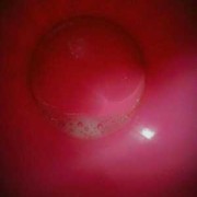 孕期吐的红粘稠是啥（孕妇吐红色粘稠液体）