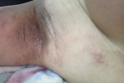 孕期腋下很痒（孕期腋下很痒起了一片红疹）