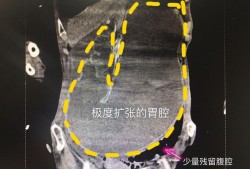 胎儿胃扩张（胎儿胃扩张）