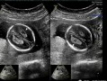 胎儿左侧脉络丛囊肿（胎儿左侧脉络丛囊肿是什么引起的）