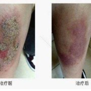 小腿皮炎湿疹怎么治,孕期小腿湿疹怎么办啊