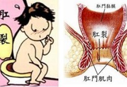 孕期肛裂出血（孕妇肛门出血怎么回事）