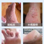 孕期脚气特别痒怎么办（怀孕脚气严重怎么办）
