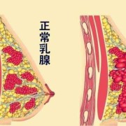 孕期乳腺增生（乳腺增生样改变是什么意思）