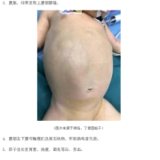 胎儿巨肠结（胎儿巨肠结 能确诊嘛）